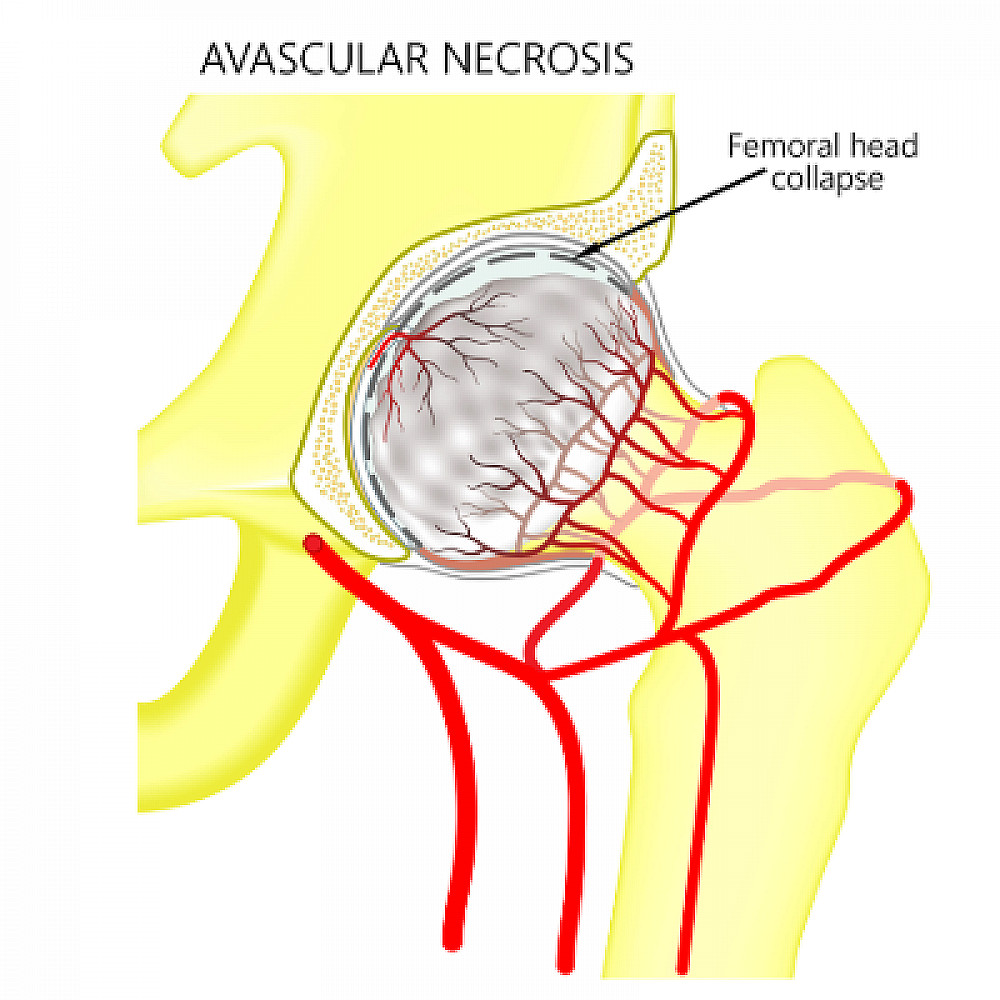 Osteonecrosis