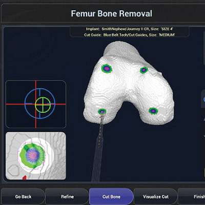 Robotic Total Knee Arthroplasty